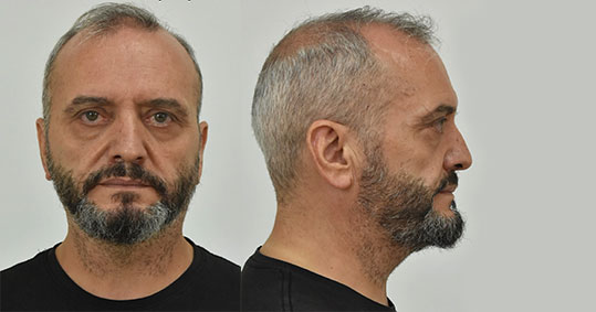 11-mixos-ilias-biastis-11xronis