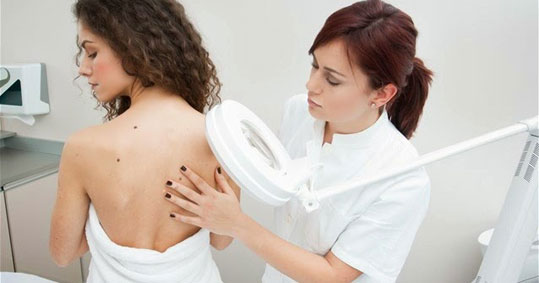 melanoma