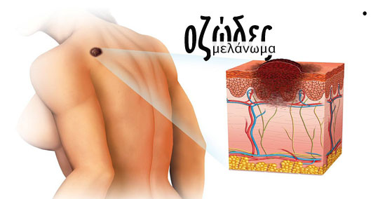 07-ozodes-melanoma-banner