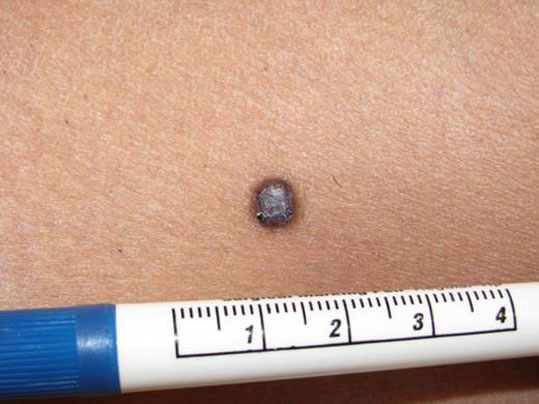 08-ozodes-melanoma-2