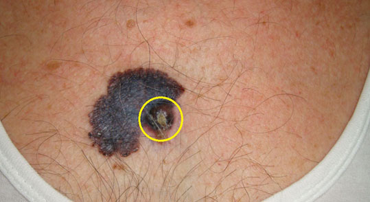 08-ozodes-melanoma-3