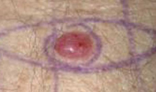 08-ozodes-melanoma-5