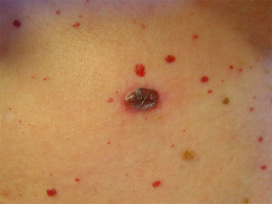 08-ozodes-melanoma-6