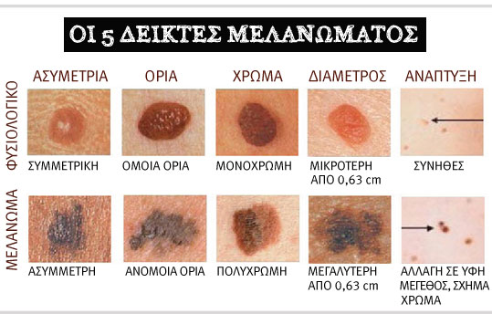 08-ozodes-melanoma-pinakas