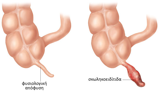 21-skolikoeiditida-2