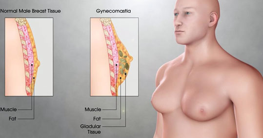 27-ginekomastia