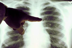 20-karkinos-europi-9